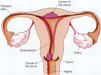 Cancer-of-the-uterus