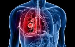 life-threatening-disease