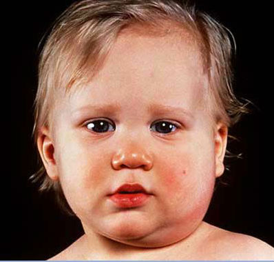 baby-mumps