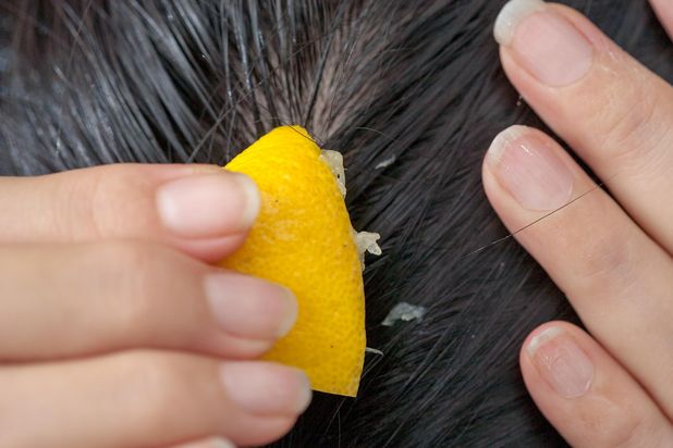 Lemon-prevent-dandruff