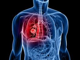 Lung-cancer
