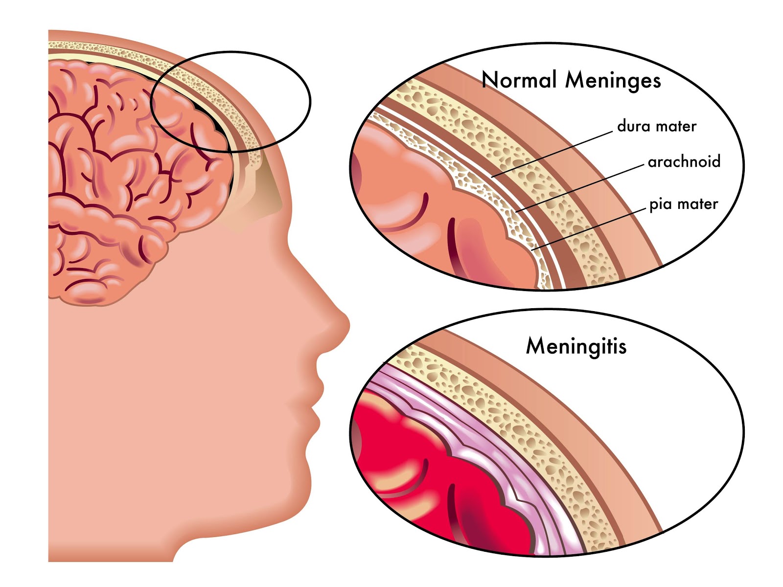 Meningitis-symptoms