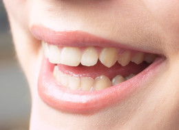 black-spots-on-teeth