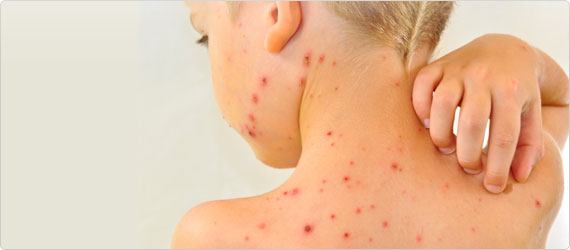 chickenpox