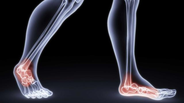 foot-pain-arthritis_FS