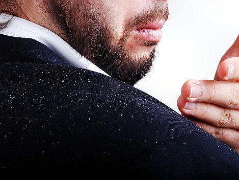 get-rid-of-dandruff