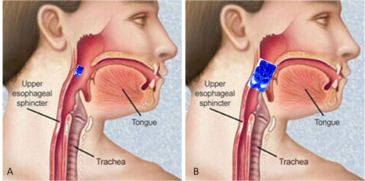 gummed-up-throat
