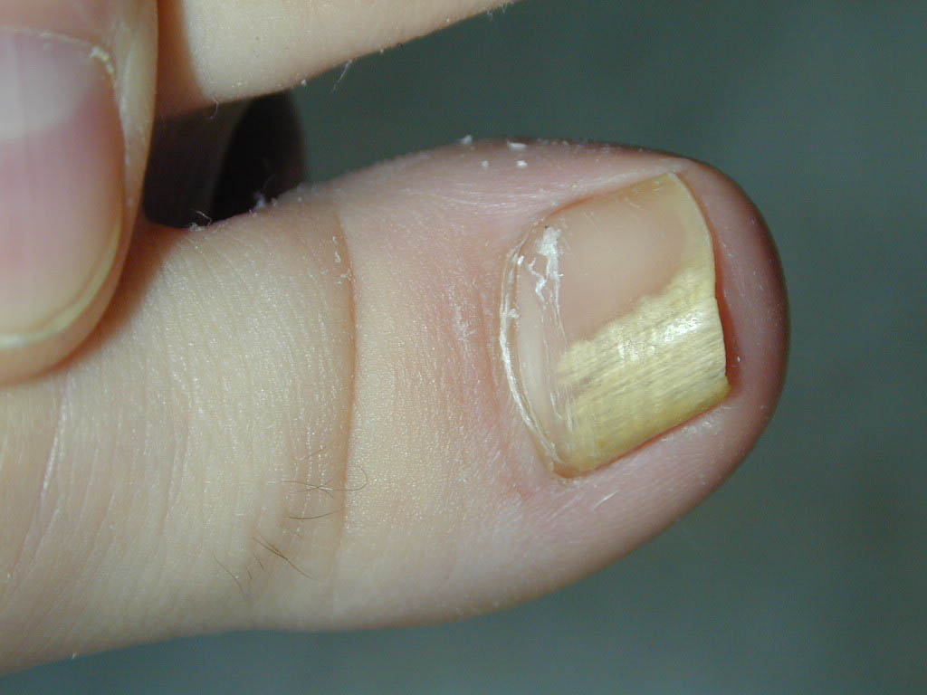 nail-disorders