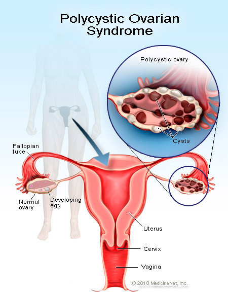 polycystic ovarian