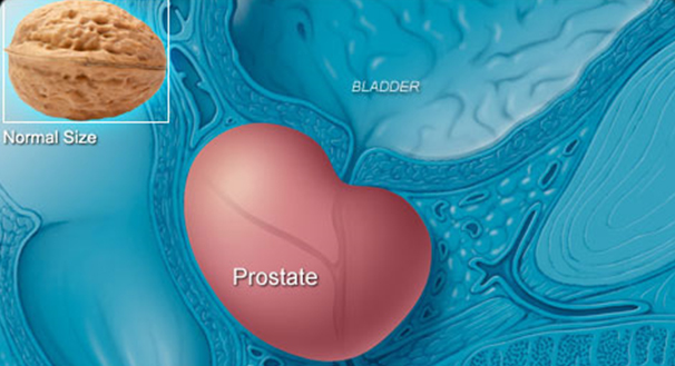 prostate-cancer