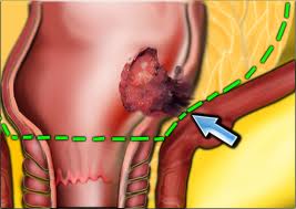 rectal-cancer-medical-health