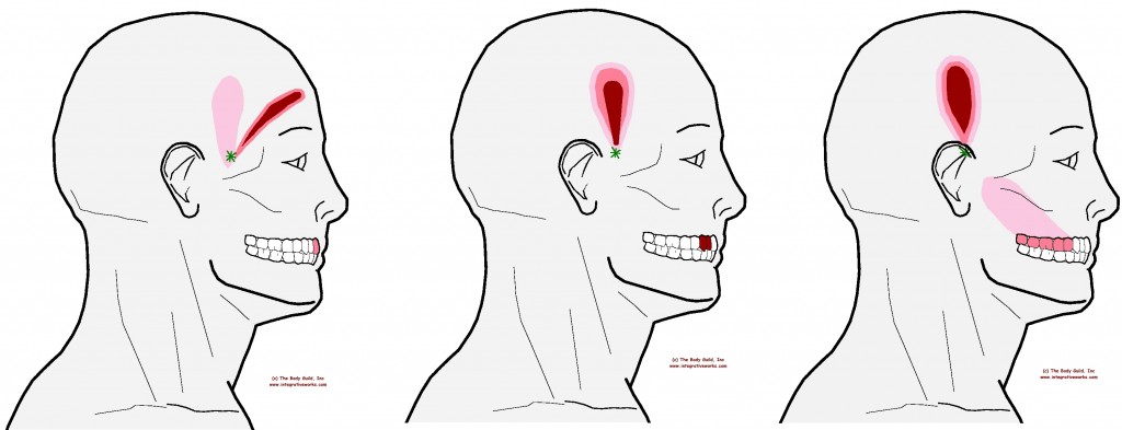 referral-temporalis-triple