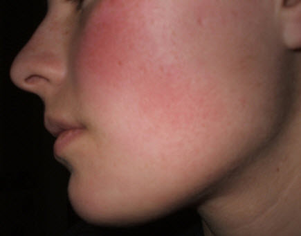 skin-rash